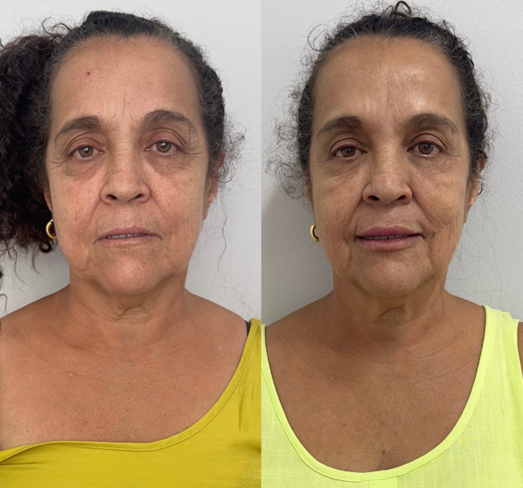 Resultado 3 de Bioestimuladores de Colágeno