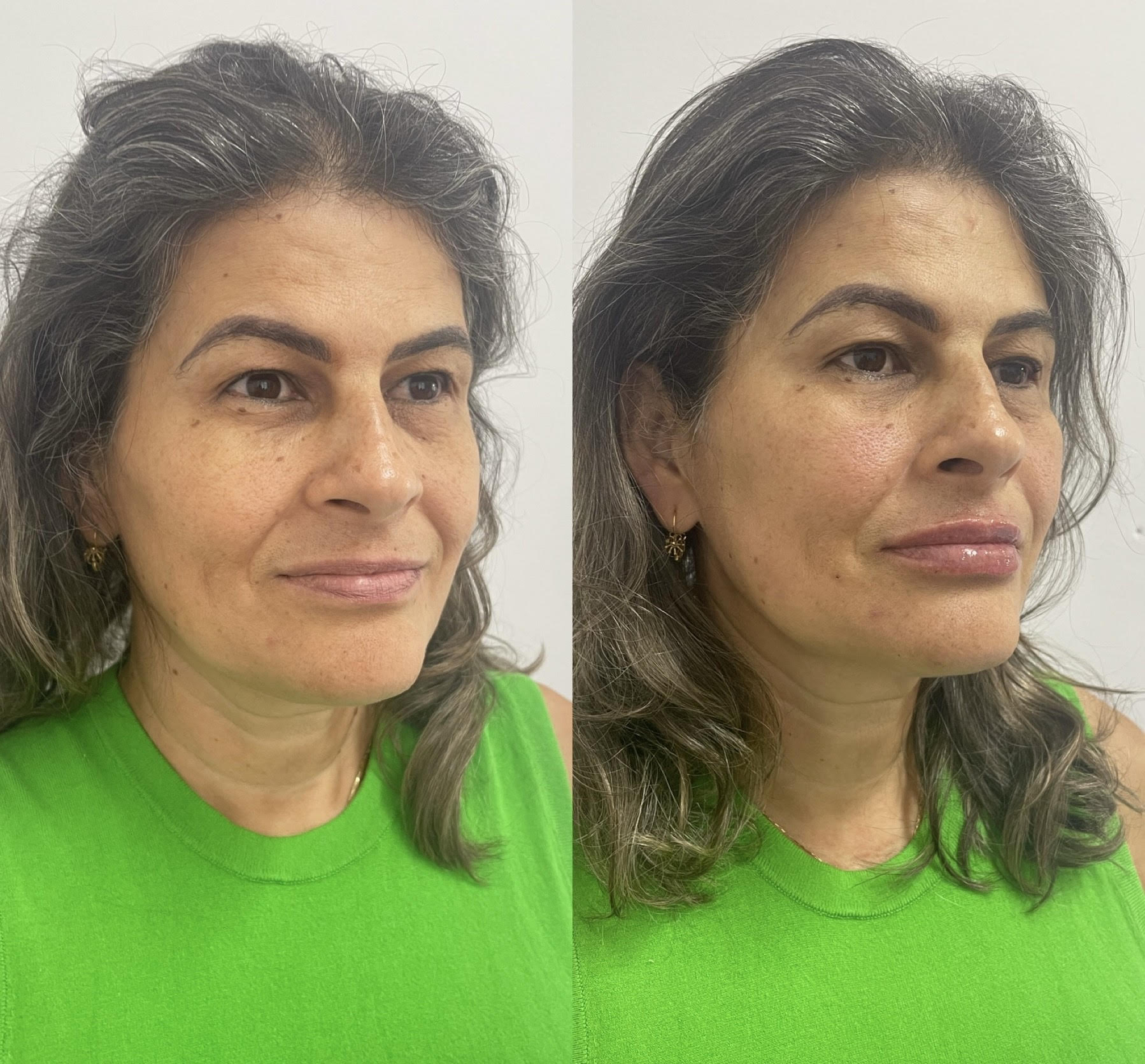 Resultado 1 de Bioestimuladores de Colágeno