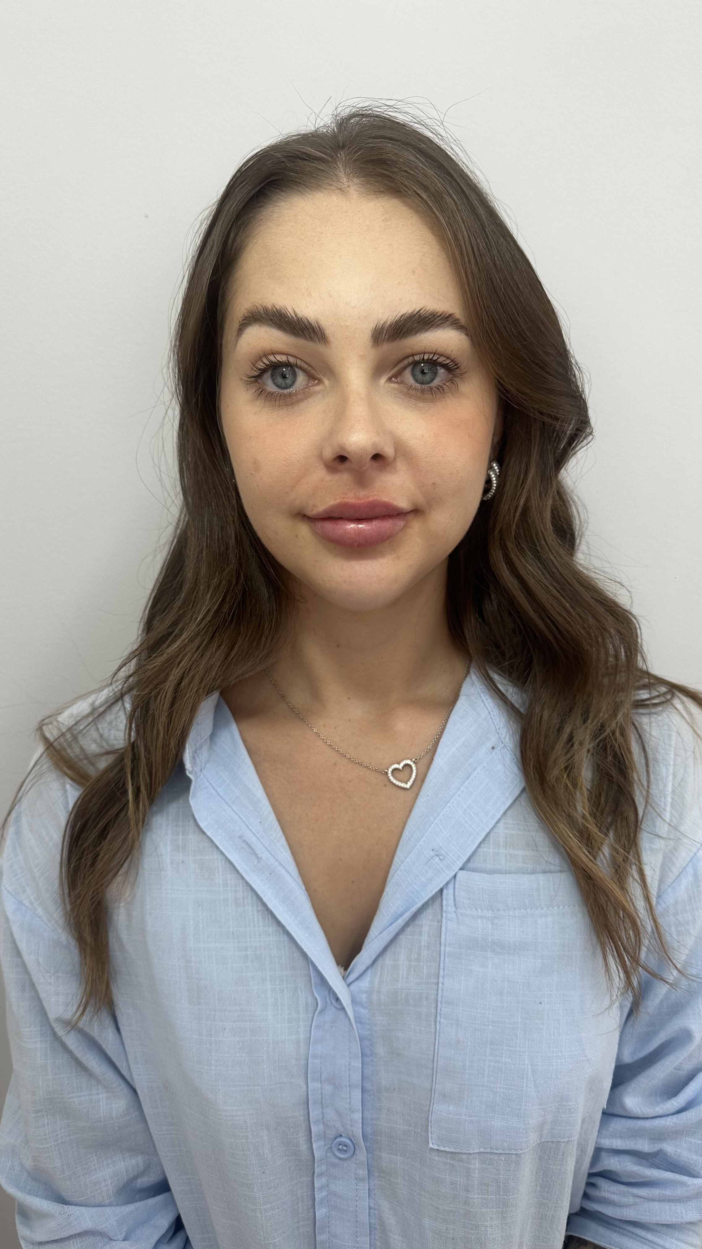 Depois - Toxina Botulínica