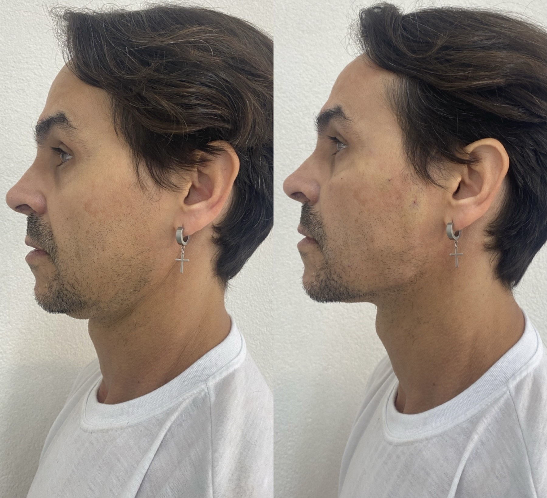 Resultado 1 de Contorno Facial e Jawline