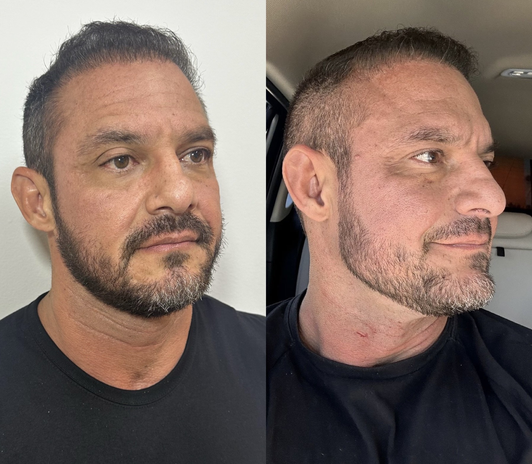 Resultado 2 de Contorno Facial e Jawline