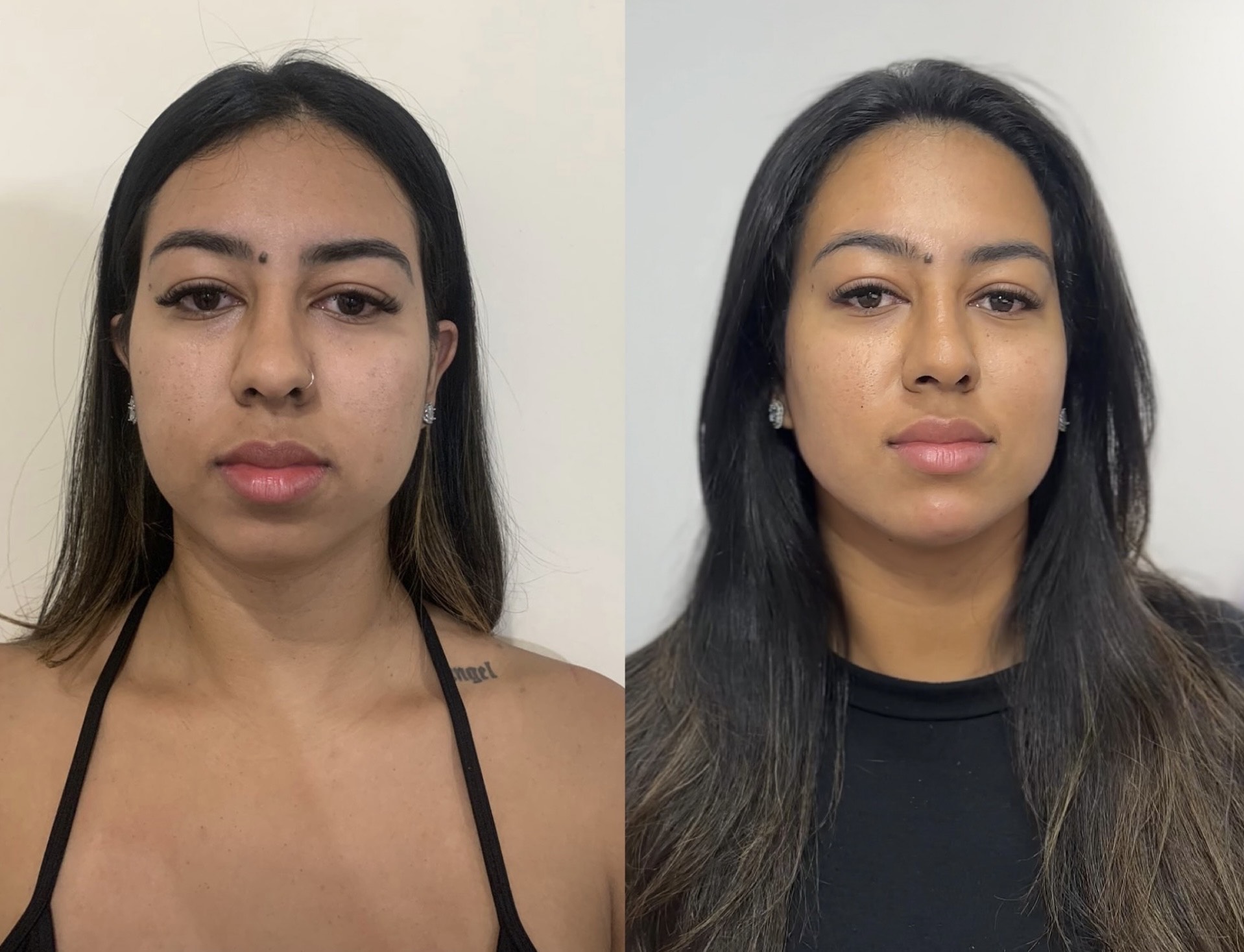 Resultado 3 de Contorno Facial e Jawline