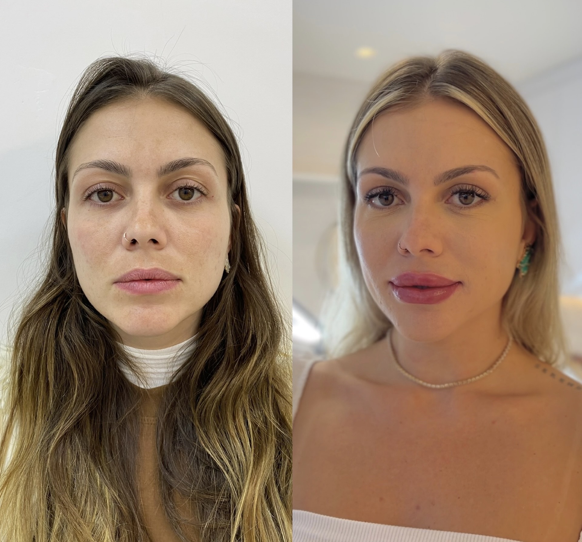 Resultado 3 de Preenchedores com Ácido Hialurônico