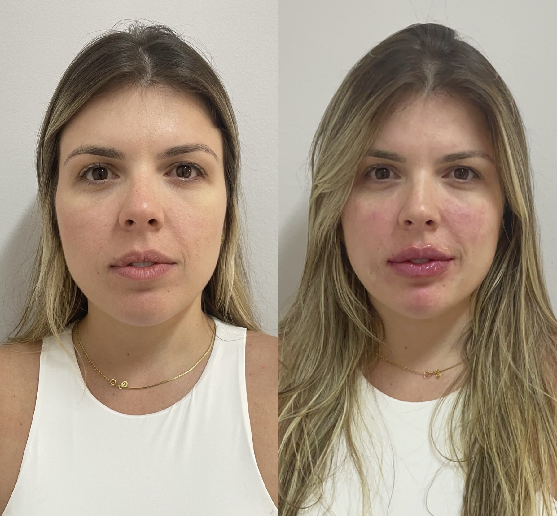 Resultado 2 de Preenchedores com Ácido Hialurônico