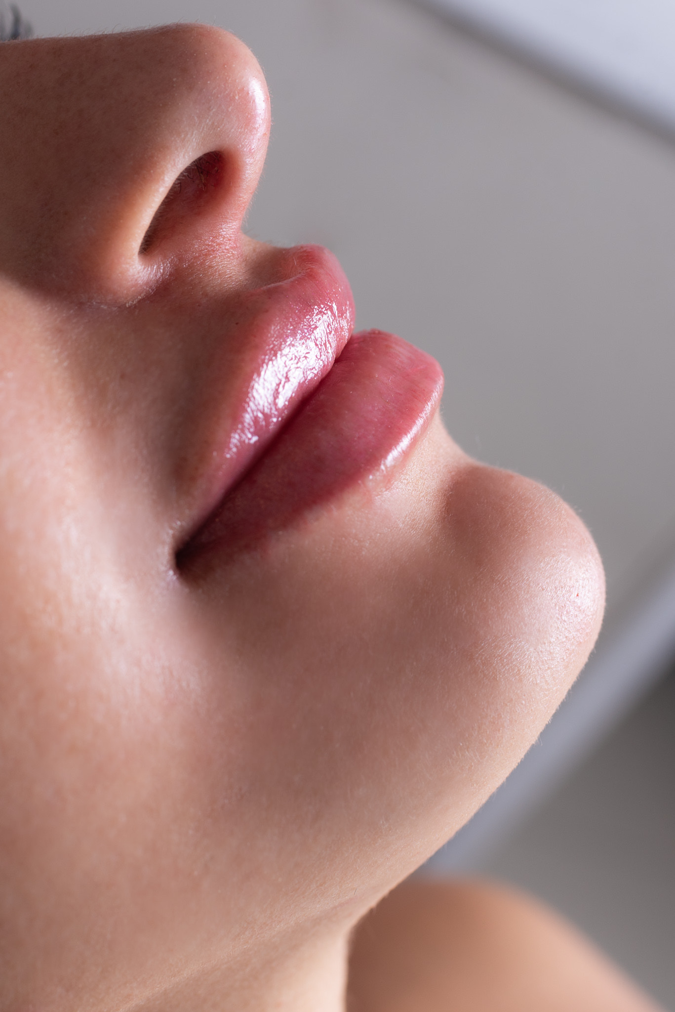 Resultado 2 de Preenchimento Labial