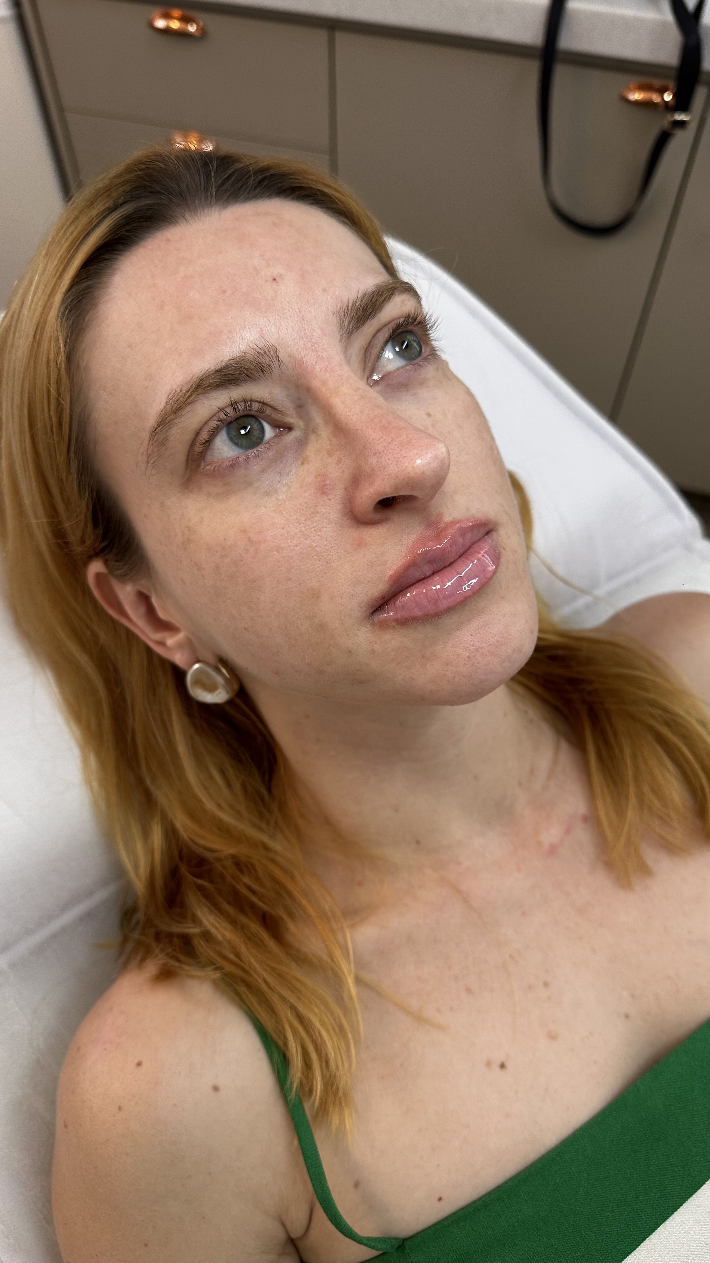 Resultado 3 de Preenchimento Labial