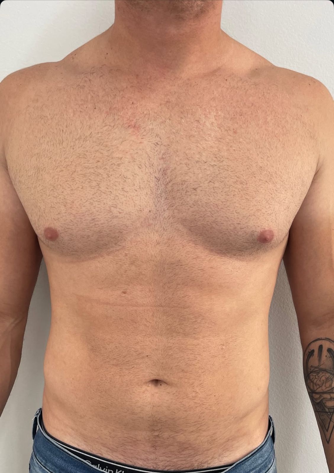 Antes - Lipo Enzimática