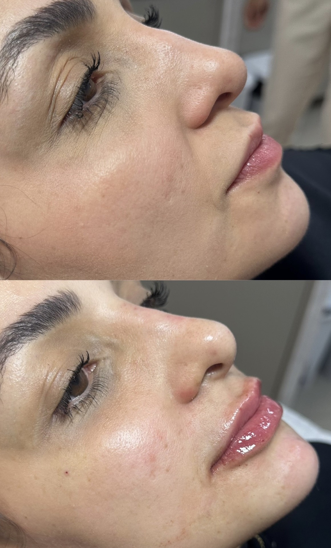 Resultado 2 de Perfiloplastia