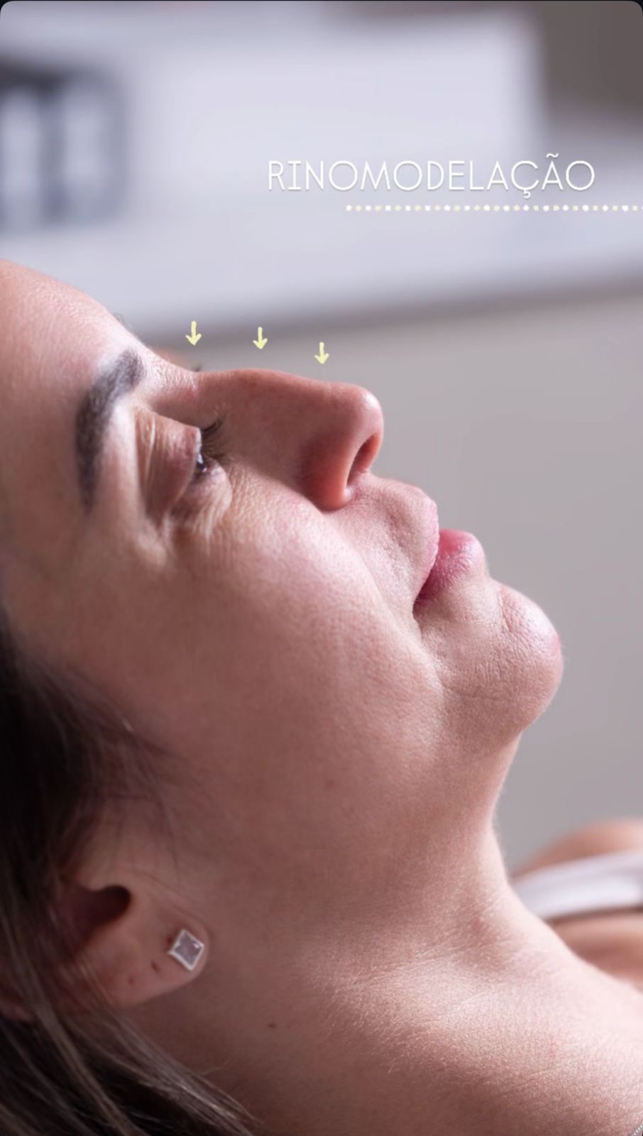 Antes - Rinomodelação