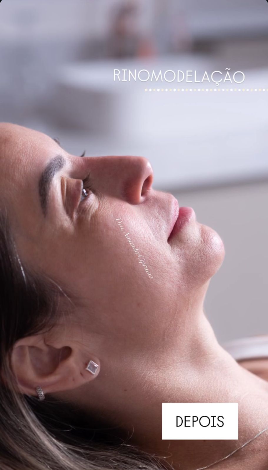 Depois - Rinomodelação