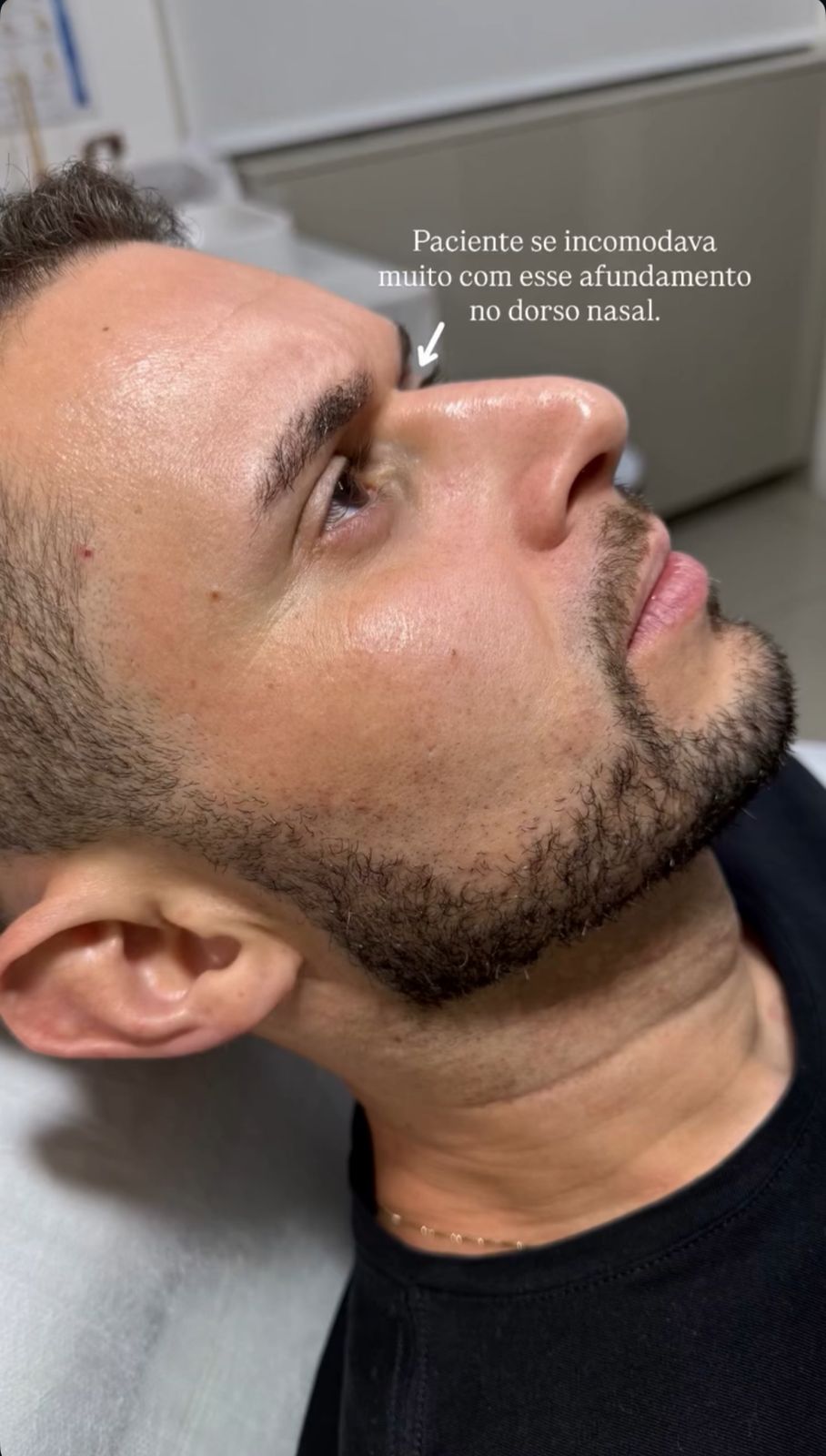 Antes - Rinocorreção sem Cirurgia