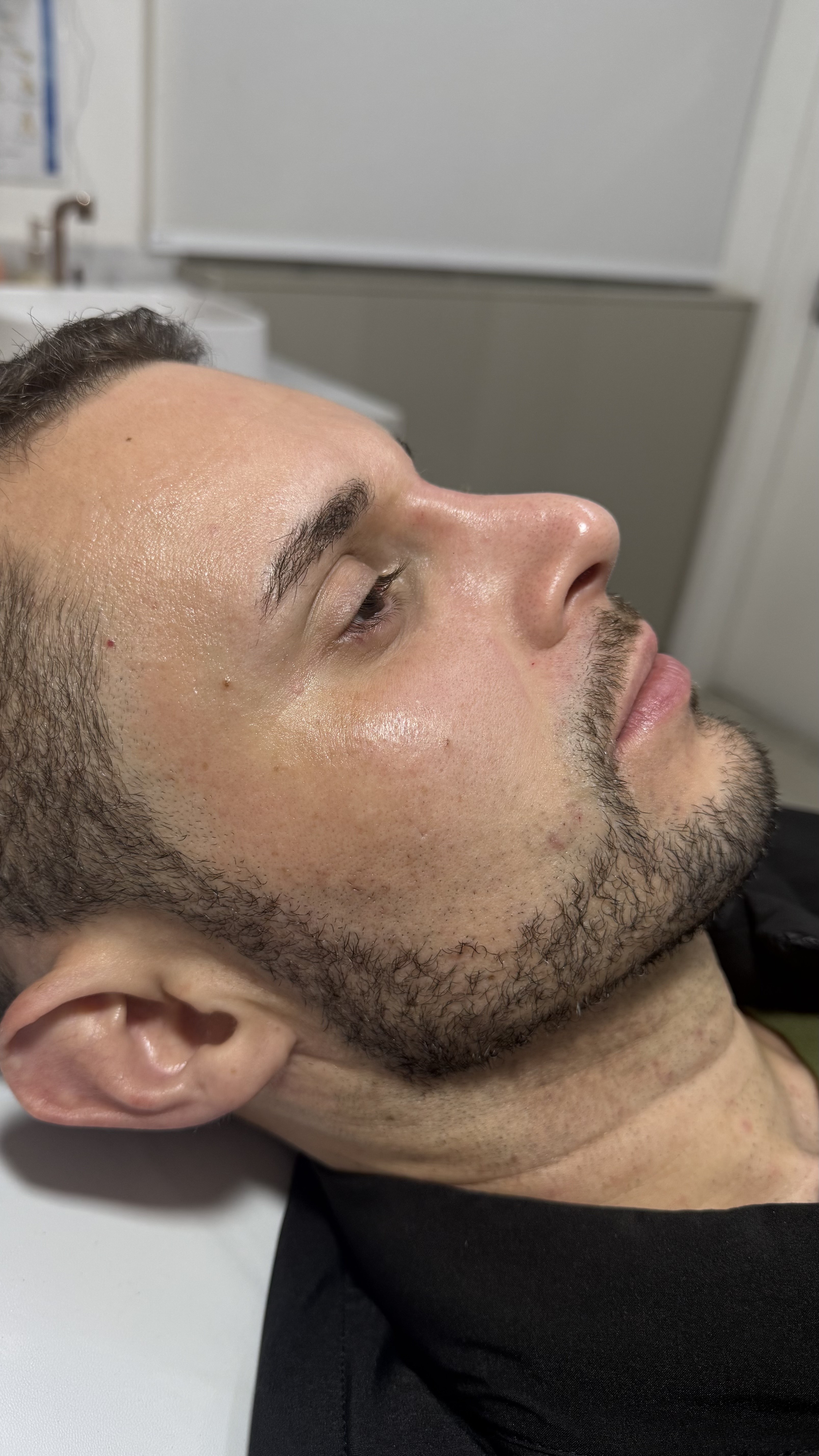 Depois - Rinocorreção sem Cirurgia