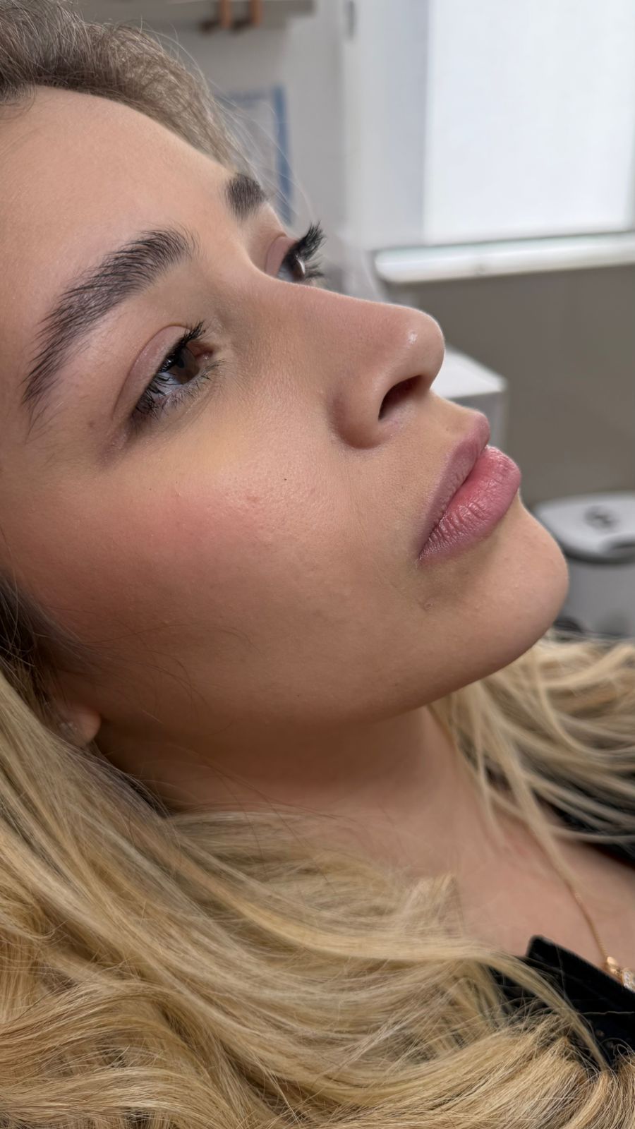 Antes - Rinocorreção sem Cirurgia