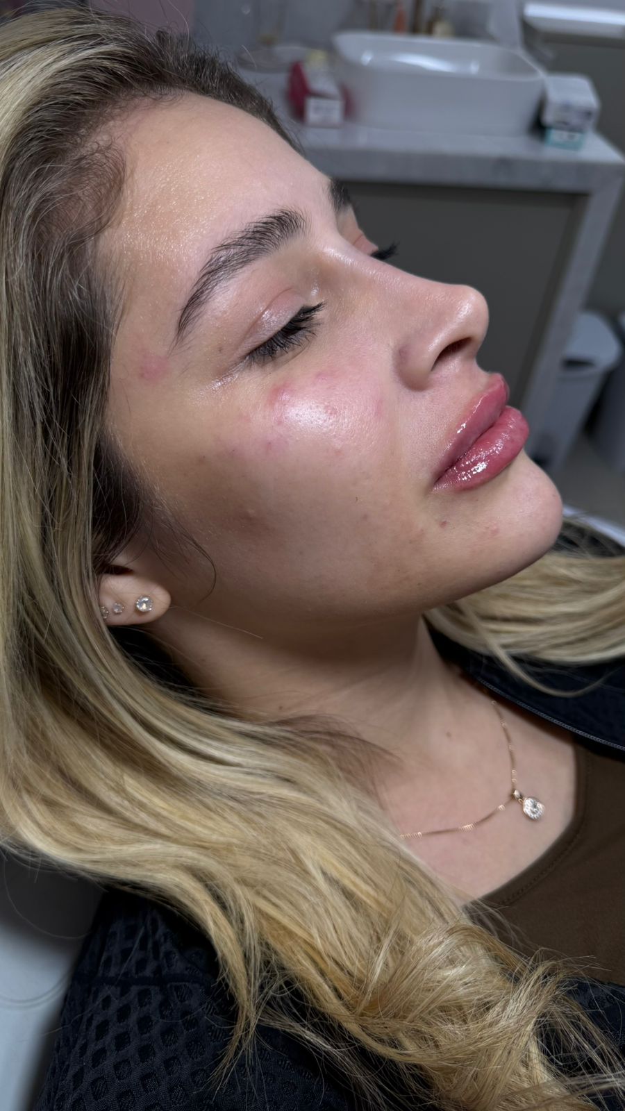 Depois - Rinocorreção sem Cirurgia