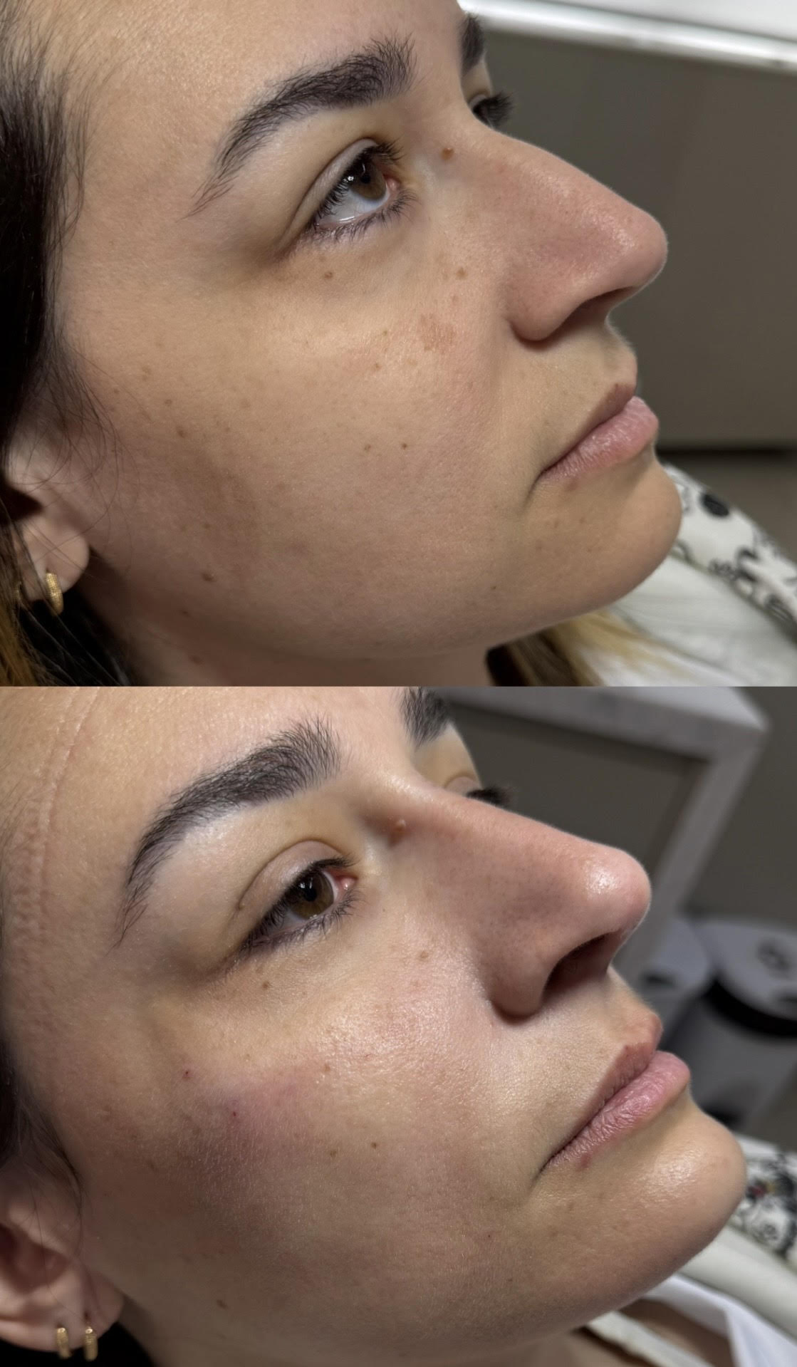 Resultado 1 de Rinocorreção sem Cirurgia